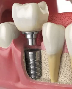 Dental Implants Dulwich Hill