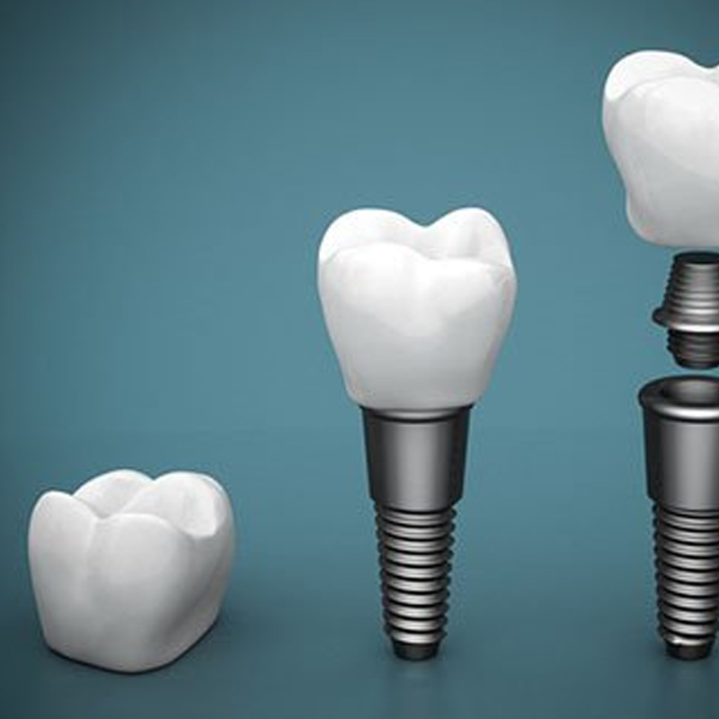 dental implants leichhardt
