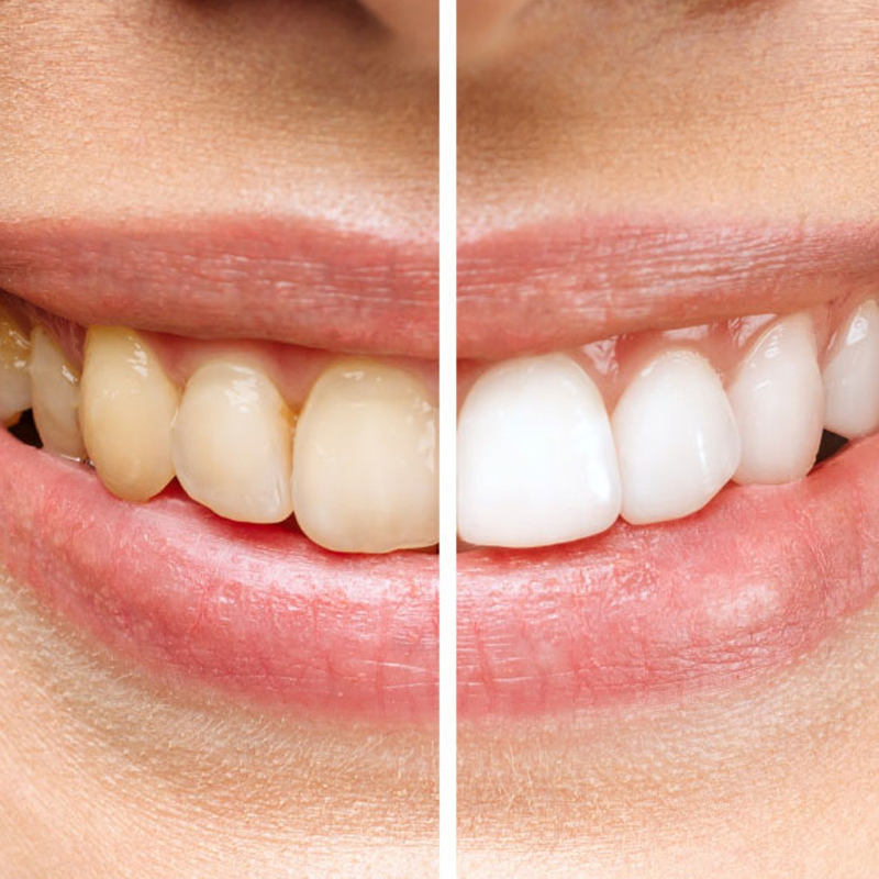 teeth whitening marrickville